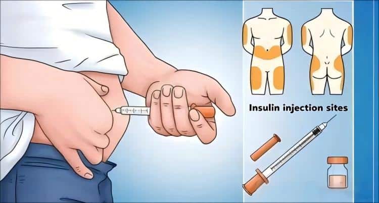 Human-body-diagram-showing-proper-insulin-injection-sites-rotation-areas