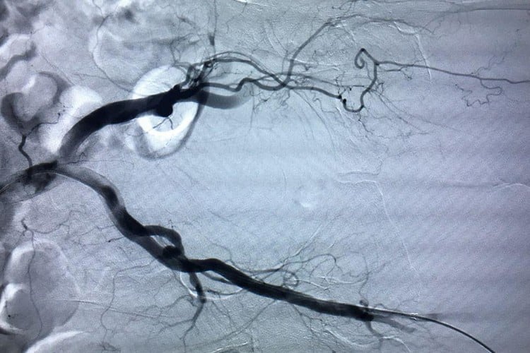 cardiovascular-catheterization-laboratory-angiography-high-pressure-injector-clinical-application