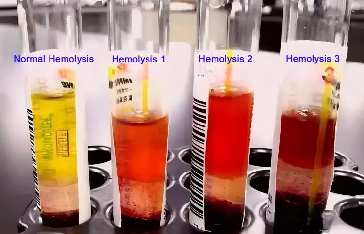 hemolysis-blood-specimen-comparison