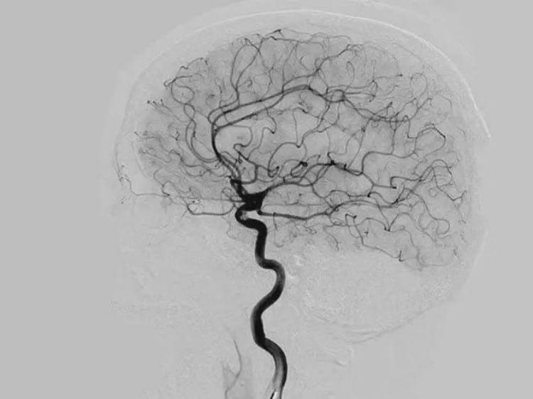neurovascular-cerebral-angiography-precision-flow-control-contrast-media-delivery