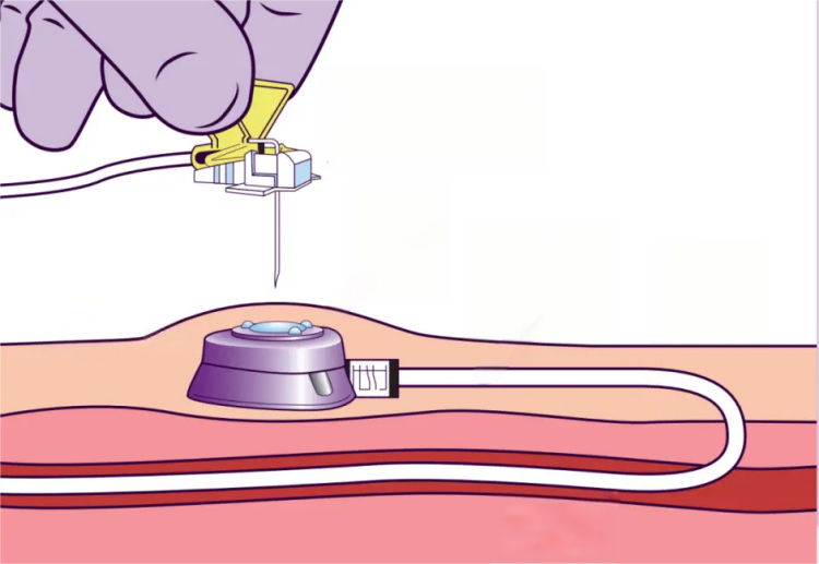 implanted-port-access