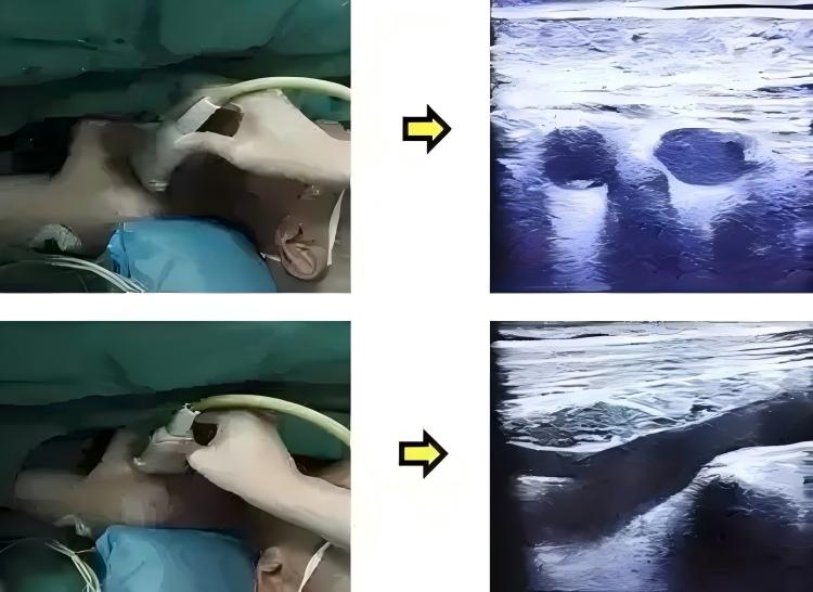 picc-line-insertion-guidance