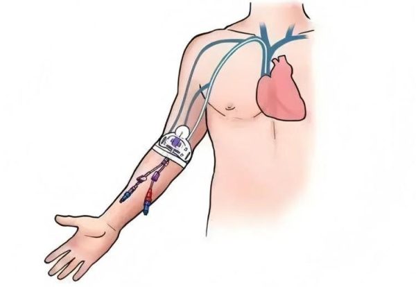 Picl Injection Understanding IV Catheter Types: A Complete Guide for Healthcare ...