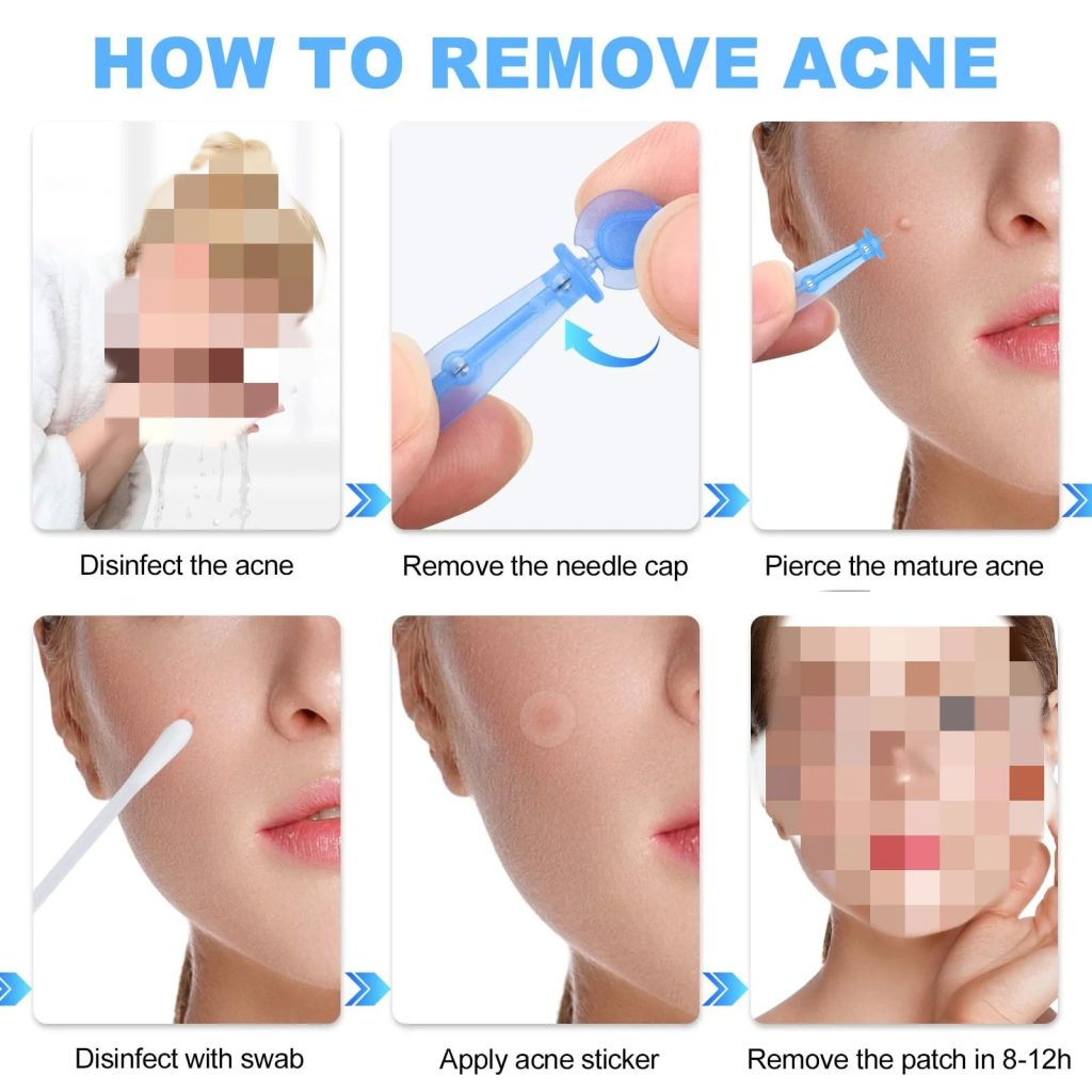 sterile stainless steel acne extraction needle 0 3mm tip close up