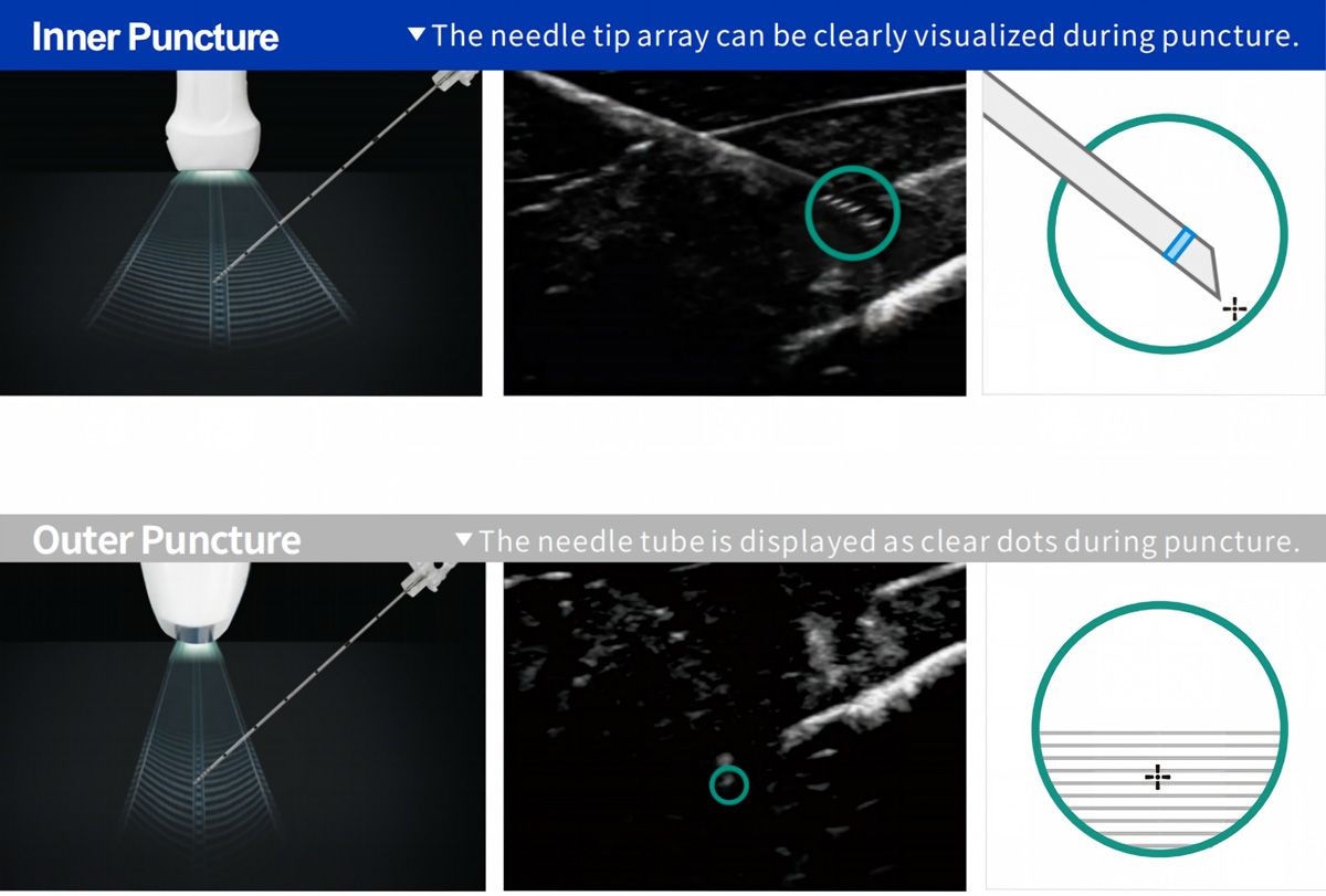 Essential Nerve Block Needle with Echogenic Technology for Precision