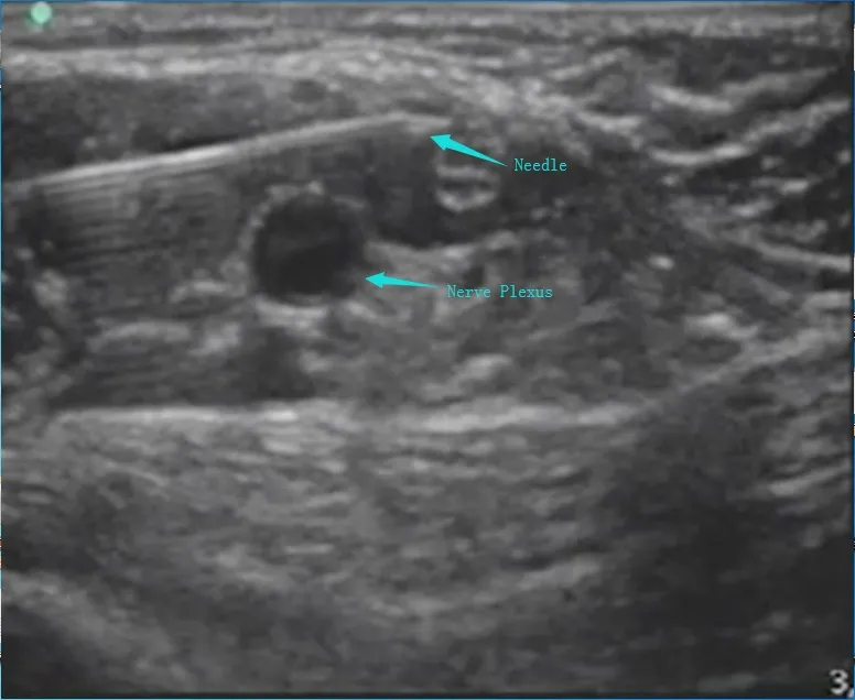 Kohope Medical Nerve Block Needle for Precise Clinic Anesthesia Procedures