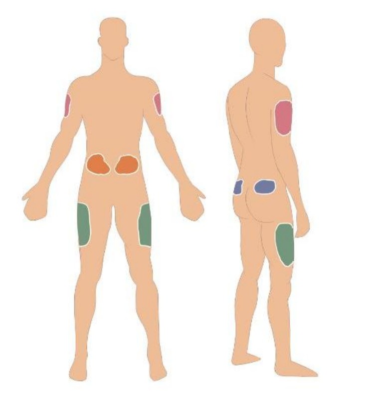 insulin-injection-site-rotation-diagram-abdomen-thigh-arm